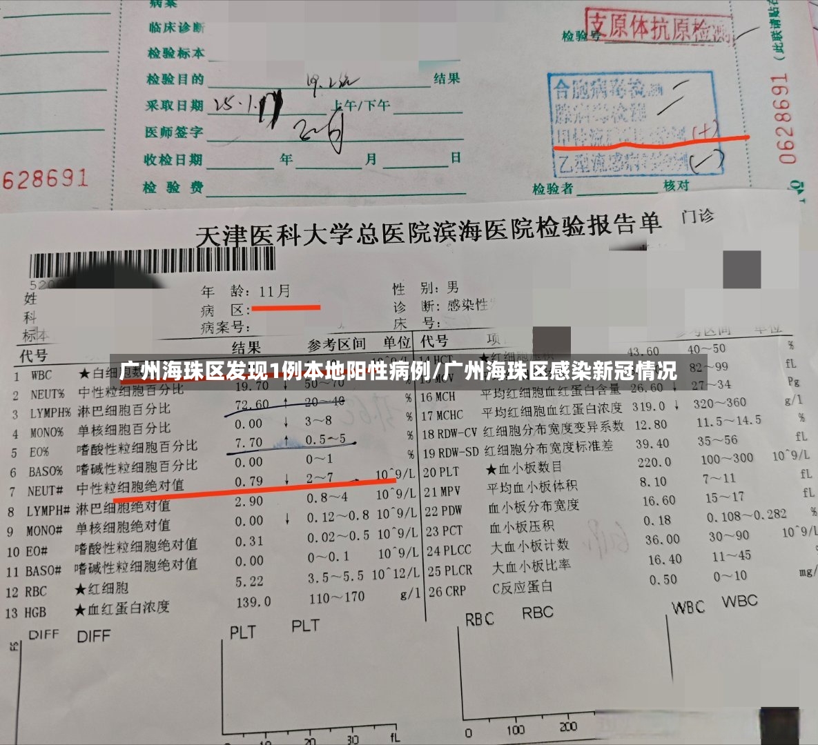 广州海珠区发现1例本地阳性病例/广州海珠区感染新冠情况